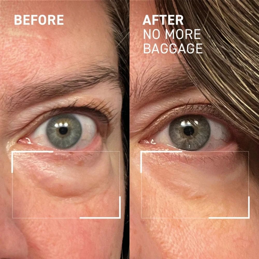 DermaLume™ – Advanced 2 in 1 Under - Eye Rejuvenation Technology - Nexo™